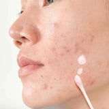 Luv it. Acne Treatment Lotion - Salicylic Acid & Tea Tree Oil for Acne-Prone Skin, 30ml
