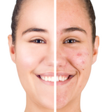 Organic Anti-Acne Nourishing Facial Wash - For WOMEN