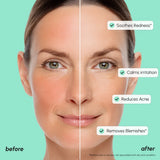Redness Soothing Azelaic Acid Serum