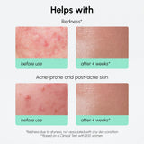 Redness Soothing Azelaic Acid Serum