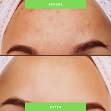 Organic Anti-Acne Two-Step System Facial Wash and Moisturizer - For WOMEN