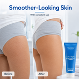 Butt & Thighs Acne Treatment Cream