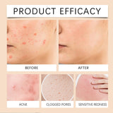 OUHOE Body Care Spray Gentle Care for Body Skin, Back Acne Cleansing, Pore and Sebum Cleaning Spray